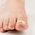 What Do Diabetic Toenails Look Like? A Step-by-Step Guide to Recognizing Signs of Foot Pain Problems