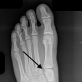 Understanding Lisfranc Injuries: Signs, Symptoms, and Treatment