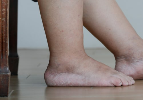 Is Your Foot at Risk? How to Detect Charcot Foot Early