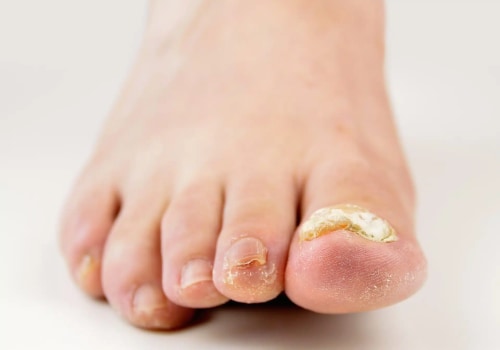 What Do Diabetic Toenails Look Like? A Step-by-Step Guide to Recognizing Signs of Foot Pain Problems