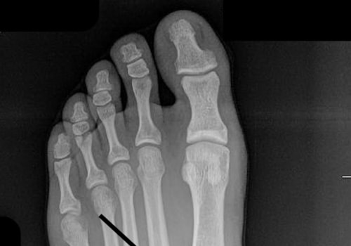 Understanding Lisfranc Injuries: Signs, Symptoms, and Treatment